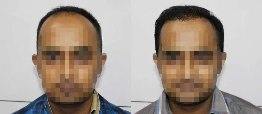 DHI before & after hair transplant results
