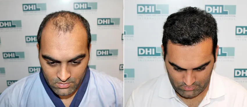 DHI before & after hair transplant results