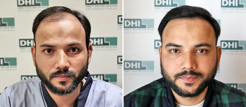 dhi gives natural hairline