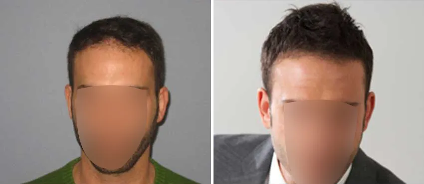 DHI before & after hair transplant results