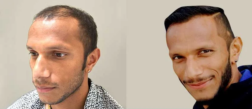 DHI before & after hair transplant results