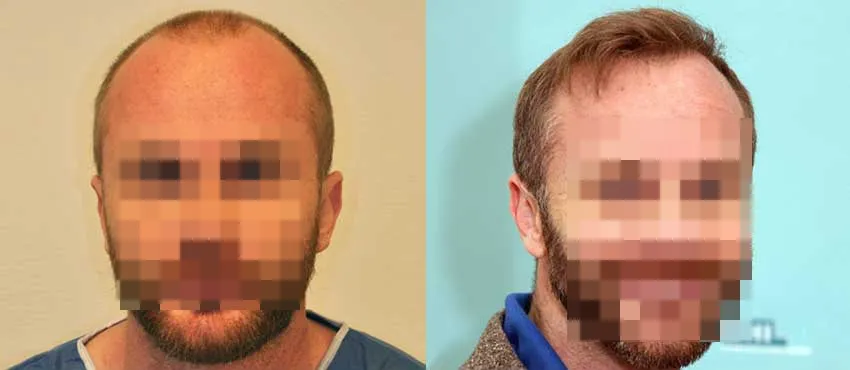 DHI before & after hair transplant results