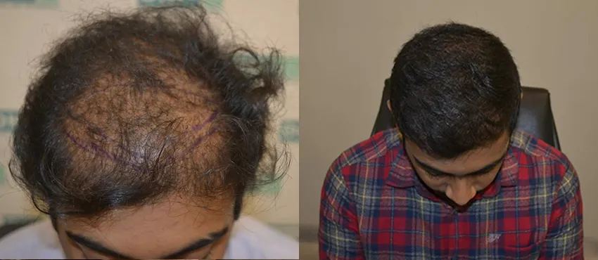 DHI before & after hair transplant results