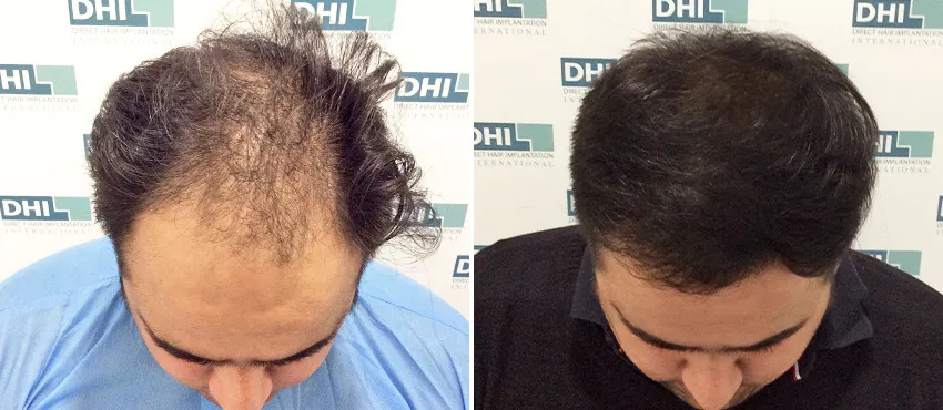 dhi gives natural hairline
