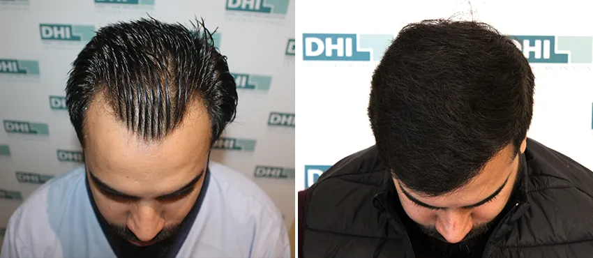 dhi gives natural hairline