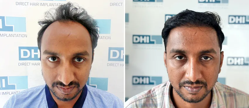 dhi gives natural hairline
