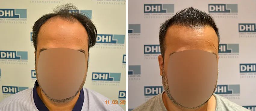 DHI before & after hair transplant results