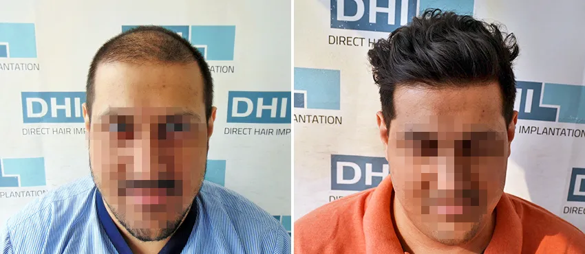 DHI before & after hair transplant results