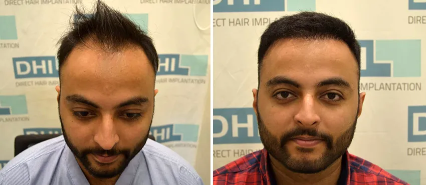 dhi gives natural hairline