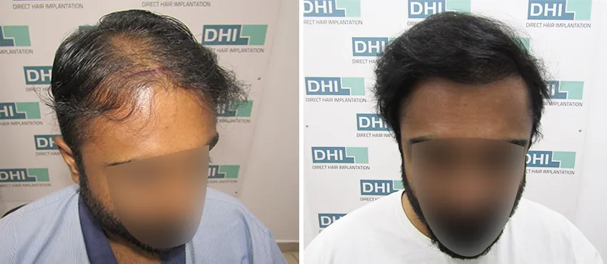 DHI before & after hair transplant results