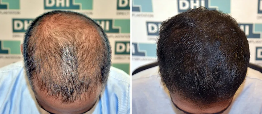 DHI before & after hair transplant results