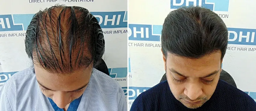 dhi gives natural hairline