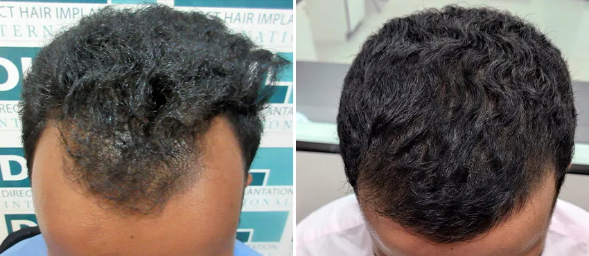 DHI before & after hair transplant results