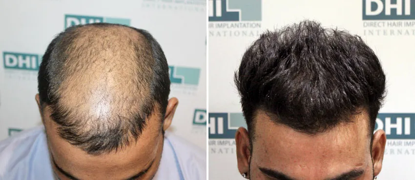 DHI before & after hair transplant results