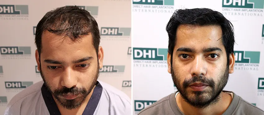 dhi gives natural hairline