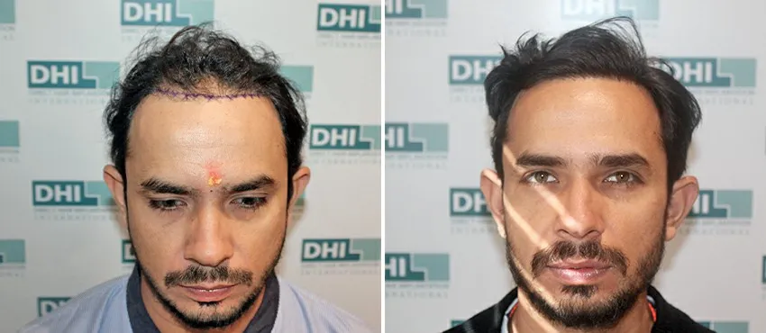 dhi gives natural hairline