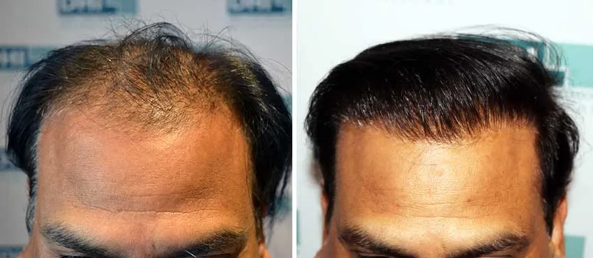 DHI before & after hair transplant results