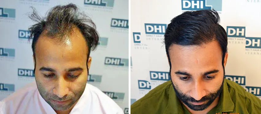 dhi gives natural hairline