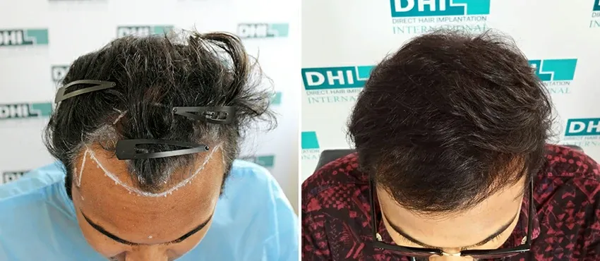DHI before & after hair transplant results