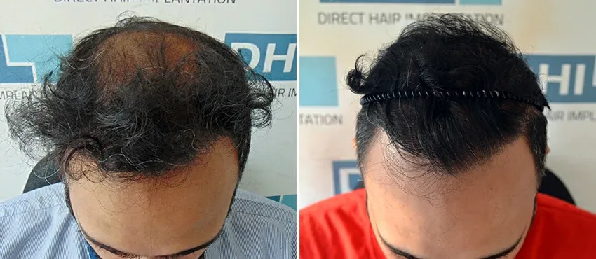DHI before & after hair transplant results