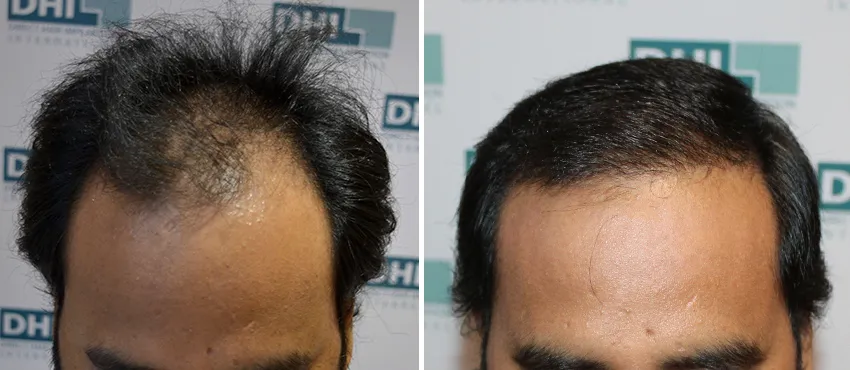 DHI before & after hair transplant results