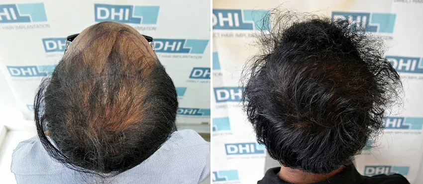 DHI before & after hair transplant results