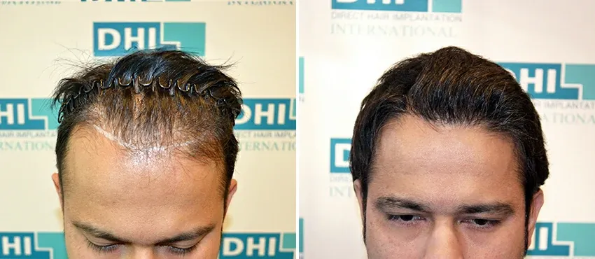 DHI before & after hair transplant results