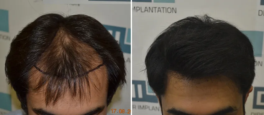 DHI before & after hair transplant results