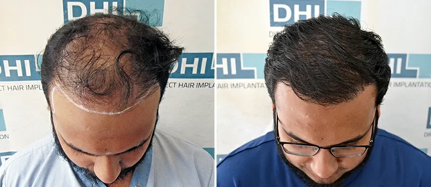 dhi gives natural hairline