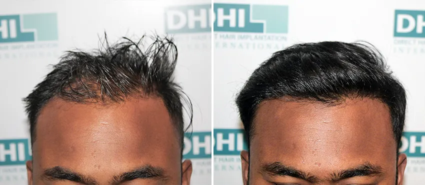 DHI before & after hair transplant results