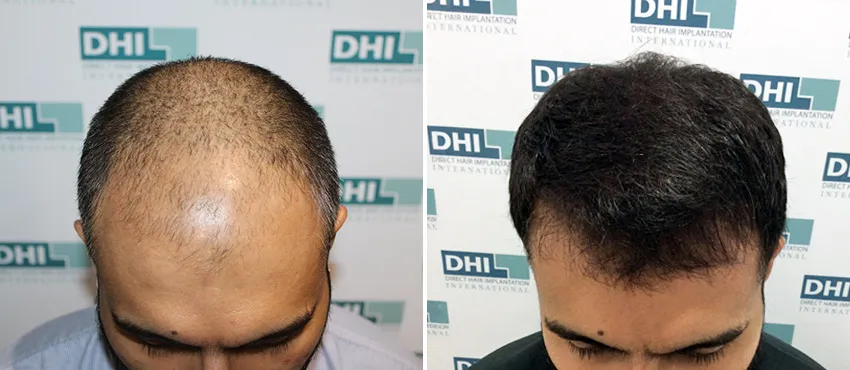 DHI before & after hair transplant results