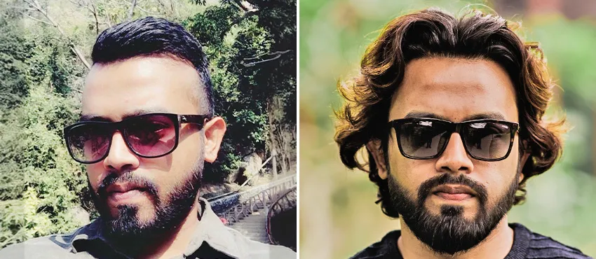 DHI before & after hair transplant results