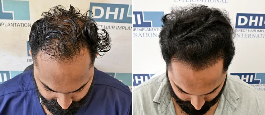 dhi gives natural hairline
