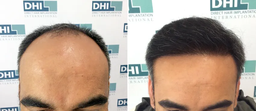 DHI before & after hair transplant results