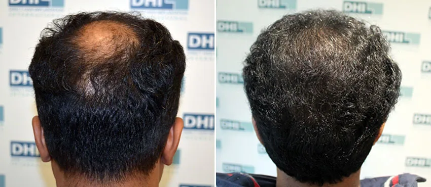 DHI before & after hair transplant results