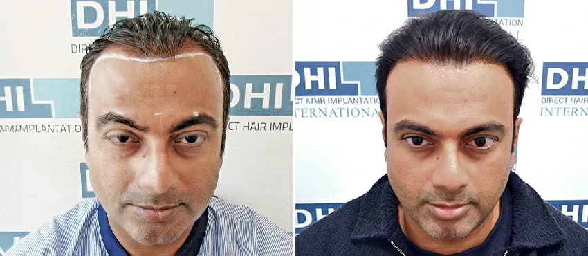 dhi gives natural hairline