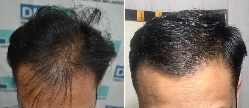 DHI before & after hair transplant results