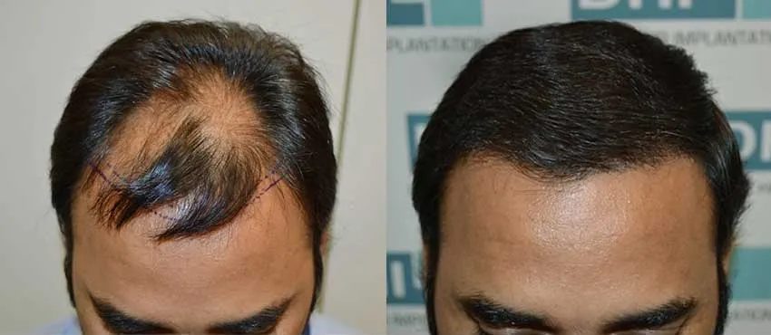 DHI before & after hair transplant results