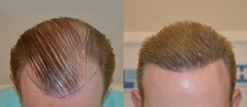 DHI before & after hair transplant results