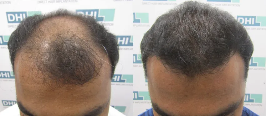 DHI before & after hair transplant results