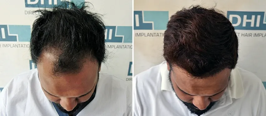 dhi gives natural hairline
