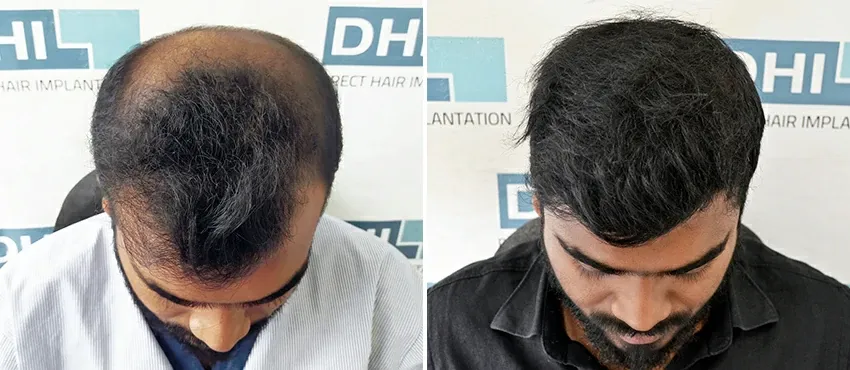 dhi gives natural hairline