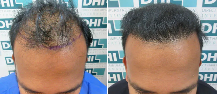 DHI before & after hair transplant results