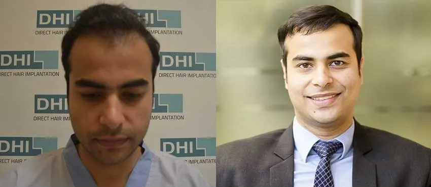 dhi gives natural hairline