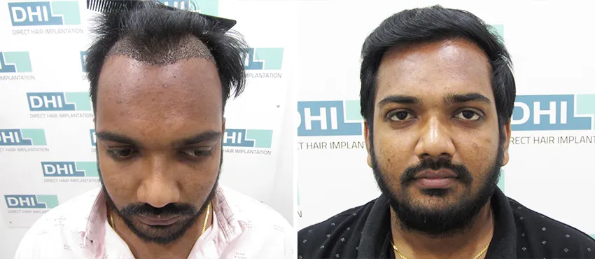 dhi gives natural hairline