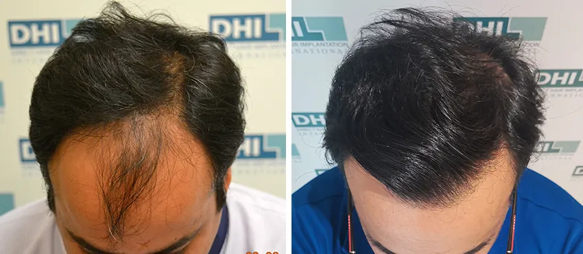 DHI before & after hair transplant results