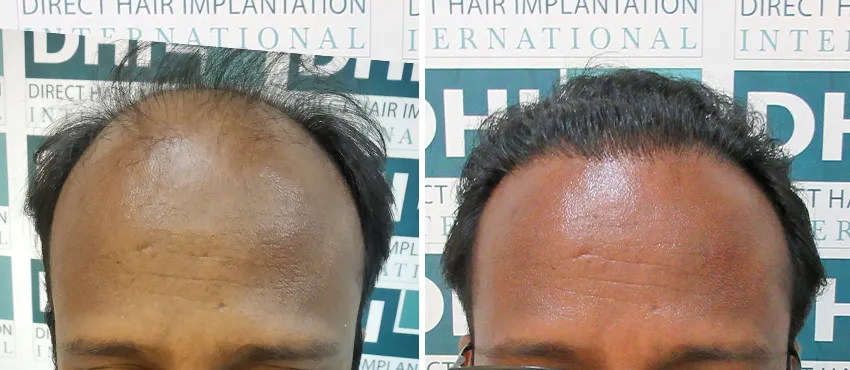 DHI before & after hair transplant results