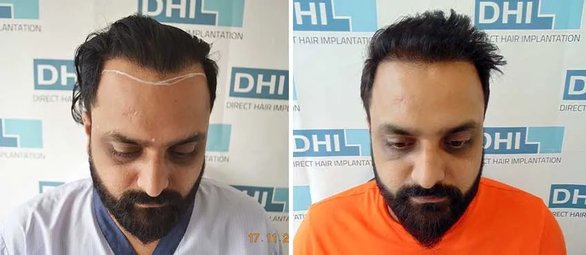 dhi gives natural hairline