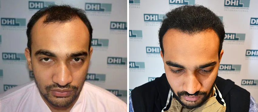 dhi gives natural hairline