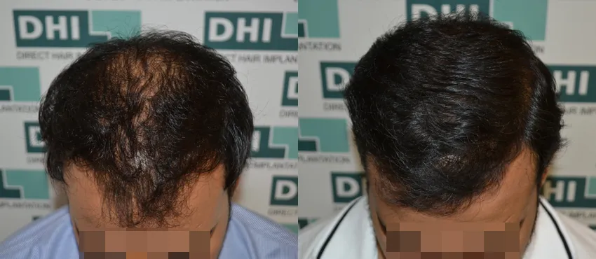 DHI before & after hair transplant results